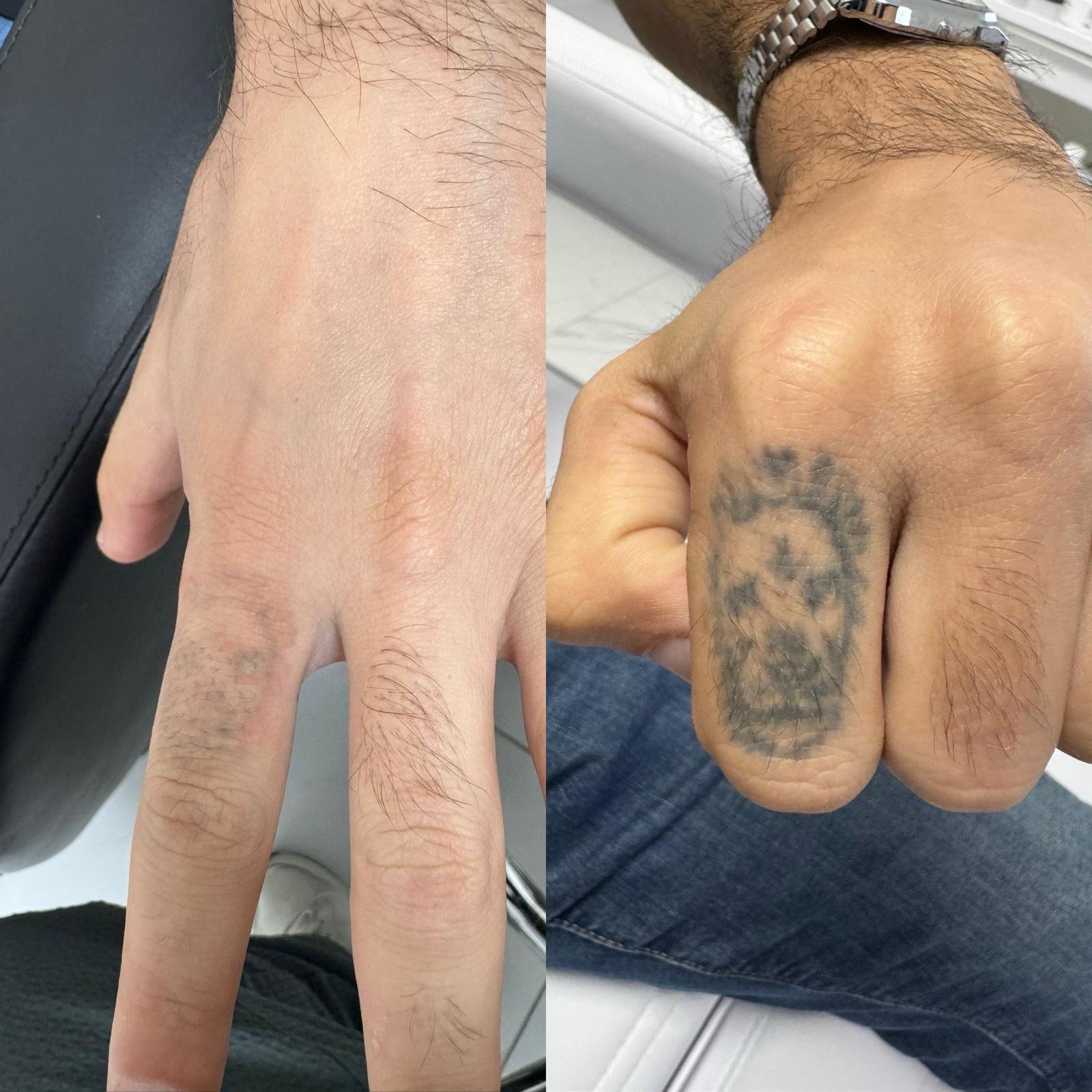 مراحل علاج إزالة الوشم بالليزر في Bareaa Clinic
