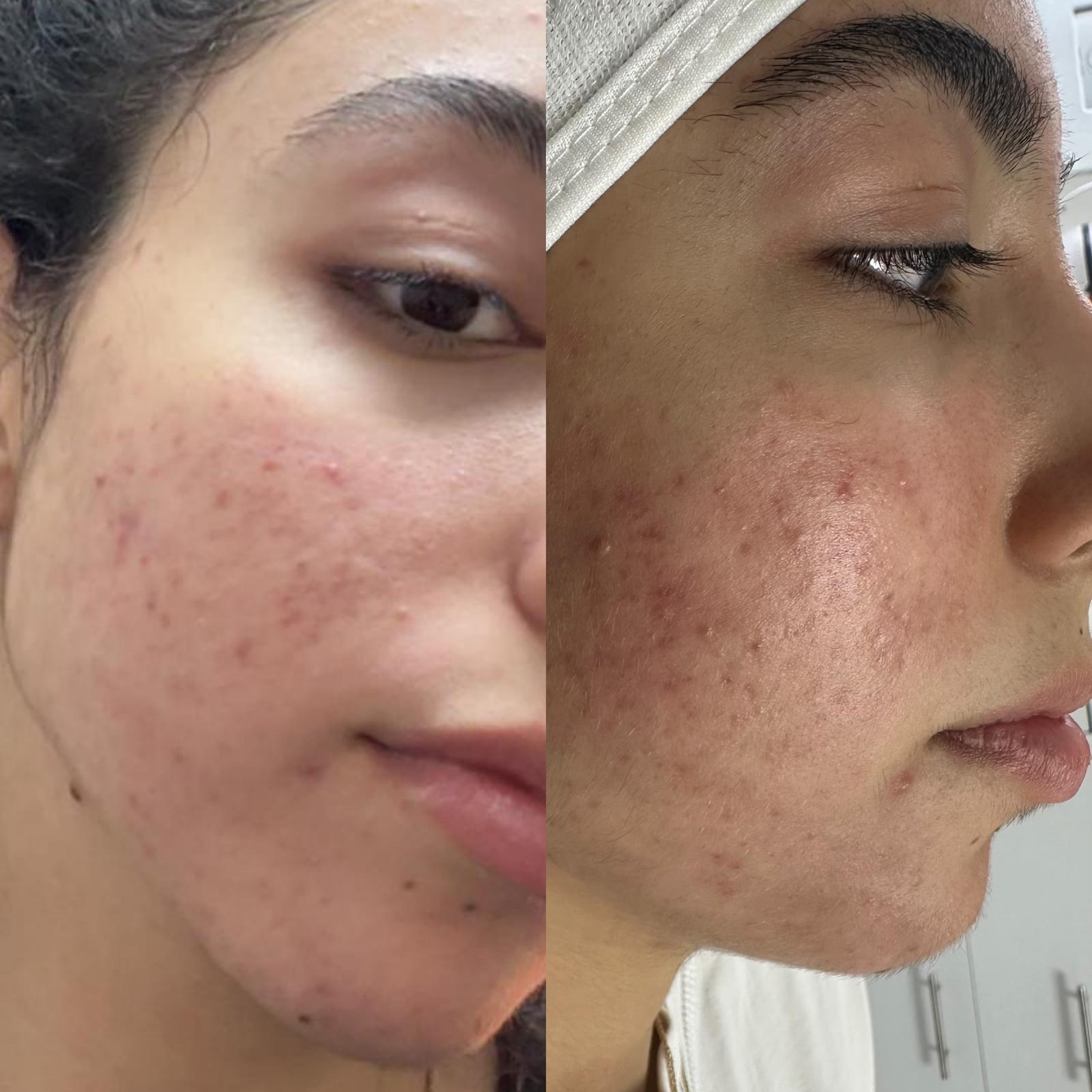 حالة حب الشباب وآثاره في Bareaa Clinic